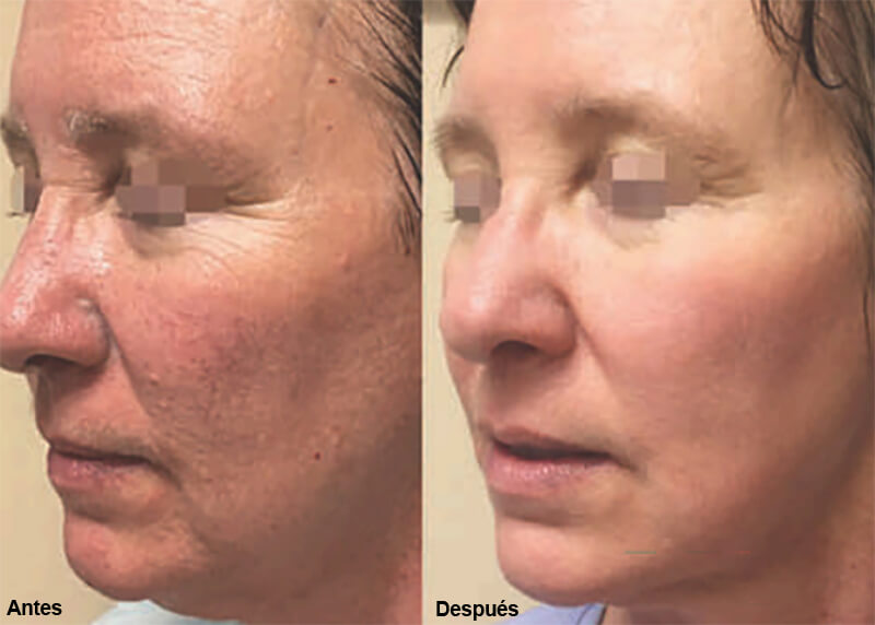 erbium laser treatment