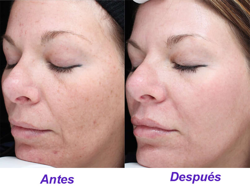 erbium laser treatment
