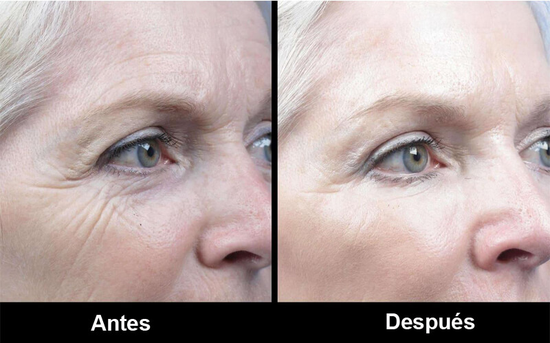erbium laser resurfacing