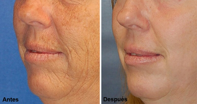 erbium laser treatment