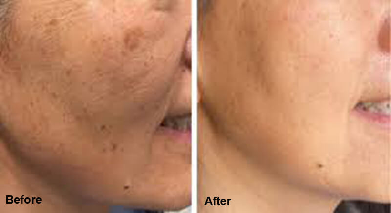 picosecond laser treatment