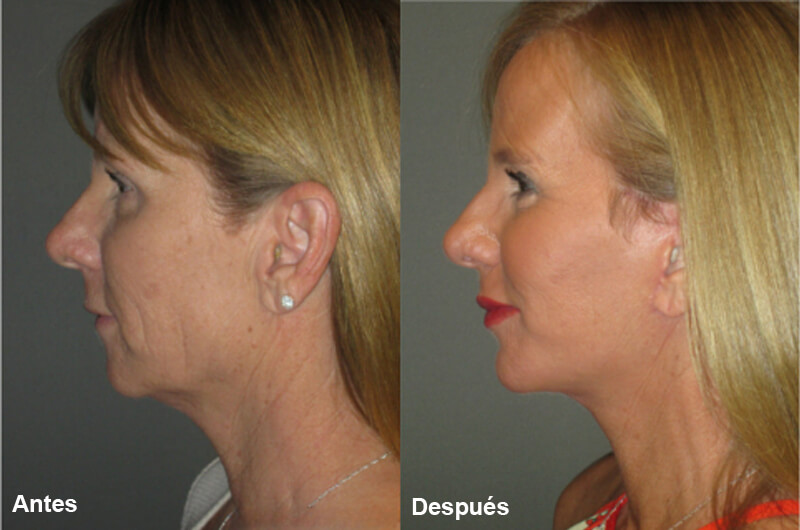 picosecond laser treatment
