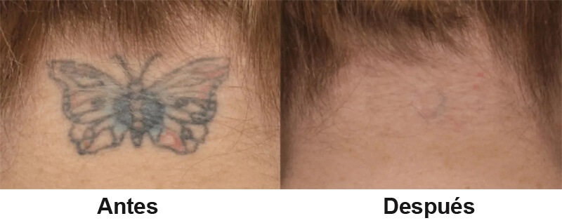 picosecond laser treatment