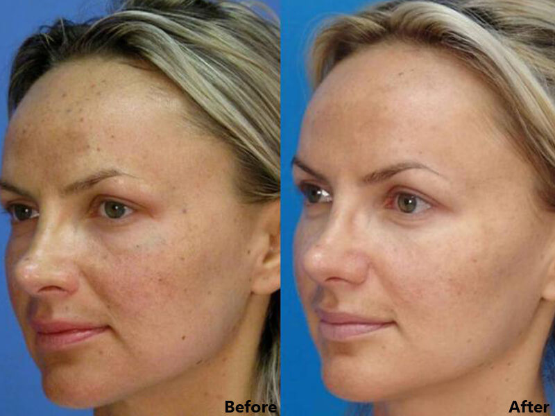 thulium laser treatment