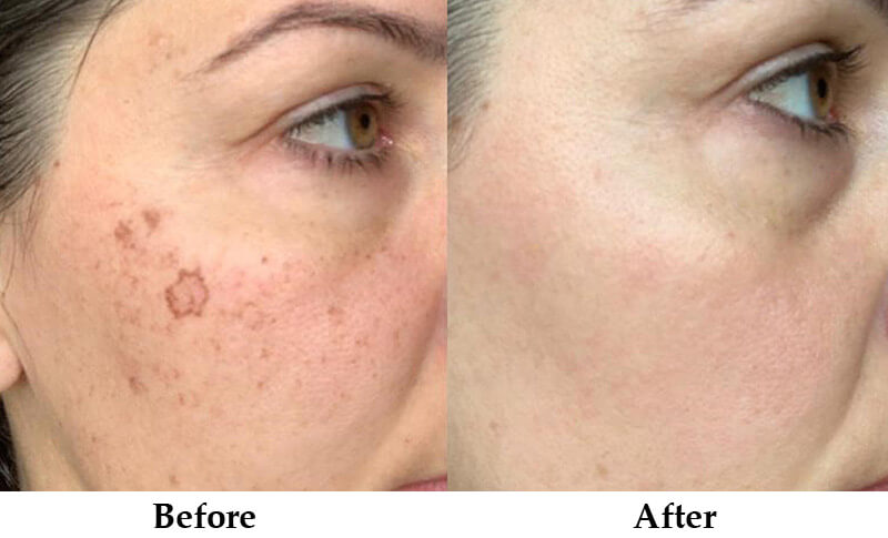 ipl skin rejuvenation machine