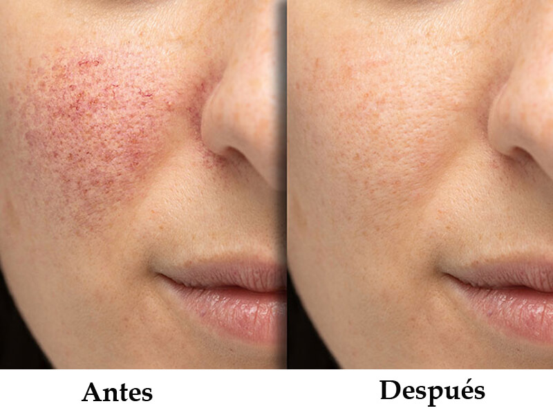 ipl skin rejuvenation machine