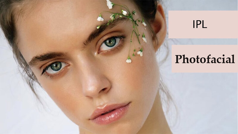 ipl photofacial machine
