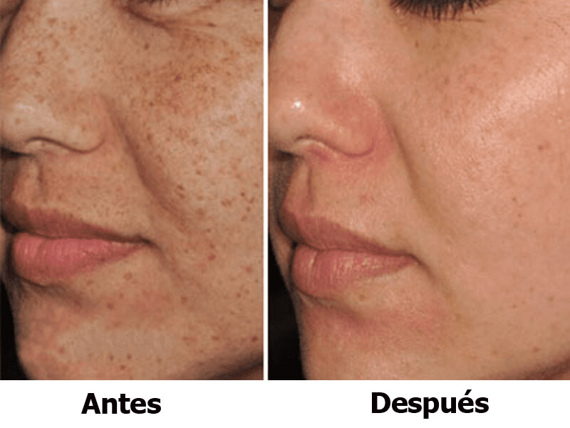 ipl skin rejuvenation treatment