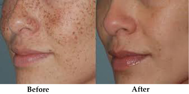 ipl skin rejuvenation