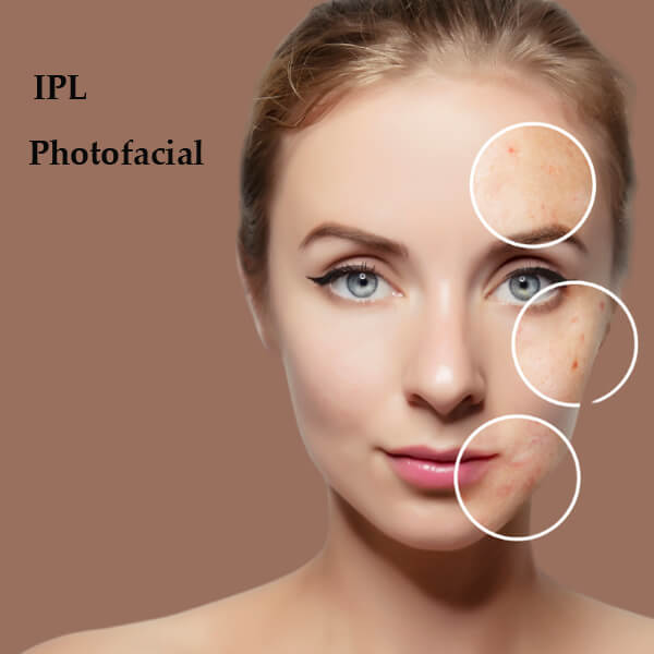 ipl photofacial machine