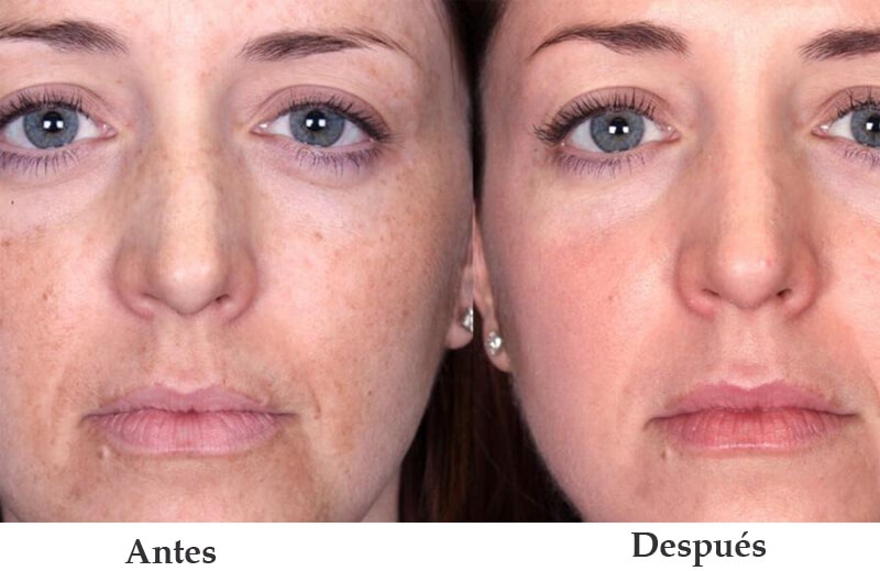 ipl skin rejuvenation machine