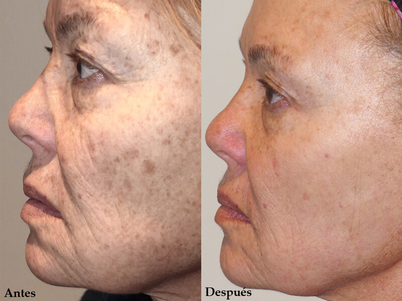 ipl photofacial machine