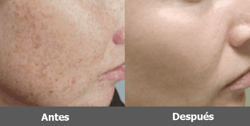 ipl skin rejuvenation