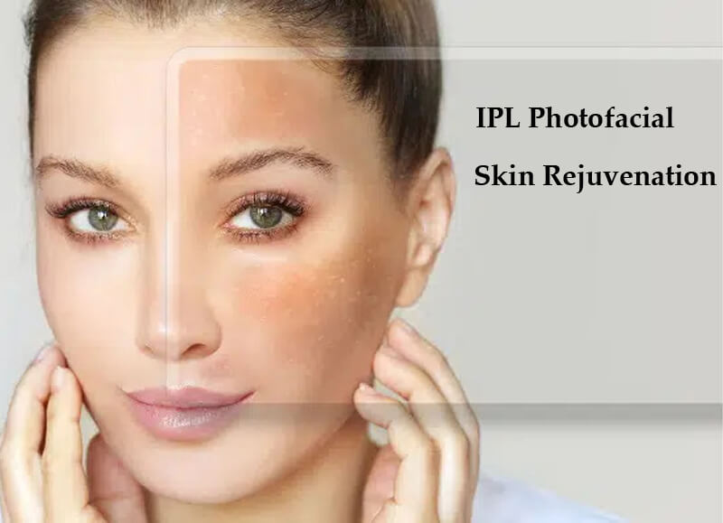 ipl photofacial machine