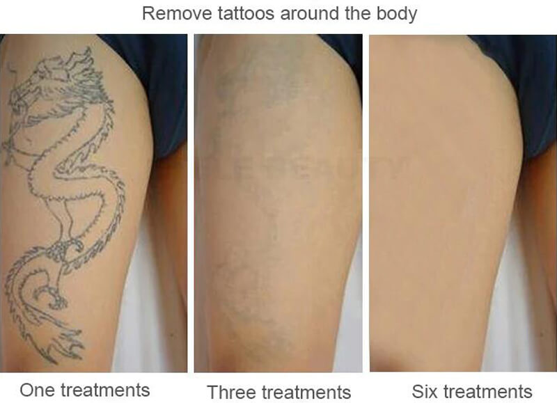picosecond laser treatment