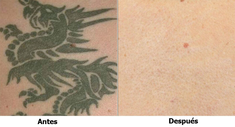 picosecond laser treatment