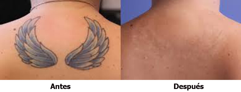 picosecond laser treatment