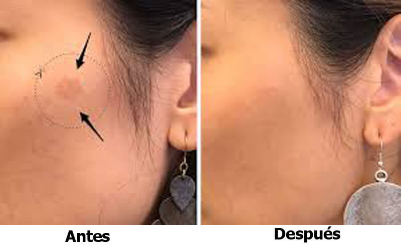 picosecond laser treatment