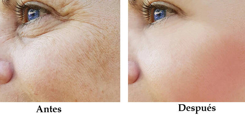 thulium laser treatment