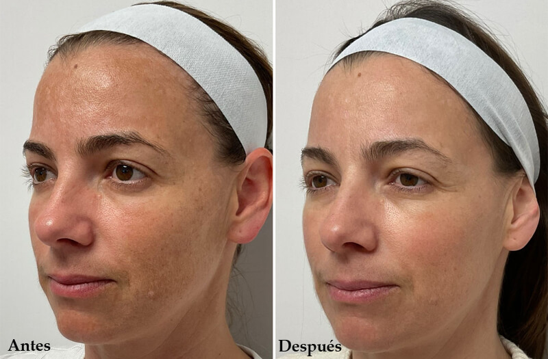 thulium laser treatment