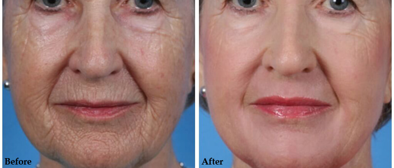 erbium laser resurfacign