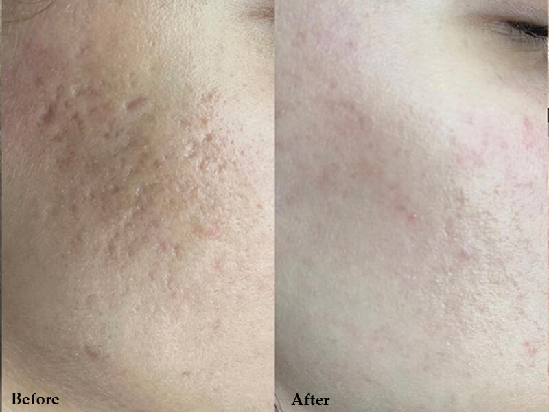 erbium laser treatment