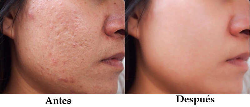erbium laser treatment