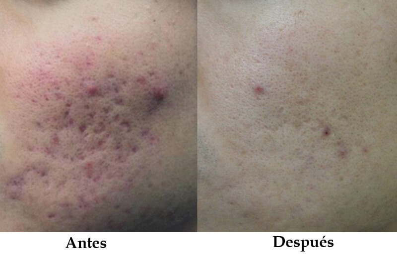 erbium laser resurfacing