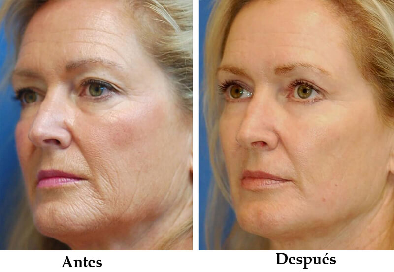 Erbium laser treatment