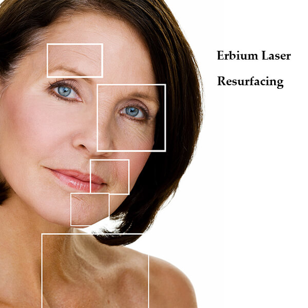 erbium laser resurfacing
