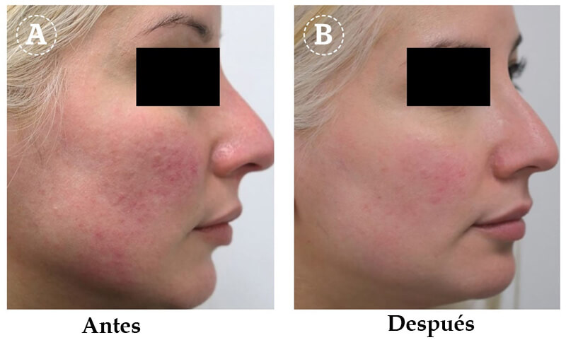 long pulsed ND YAG laser