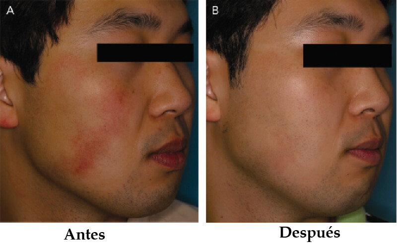 long pulsed nd yag laser