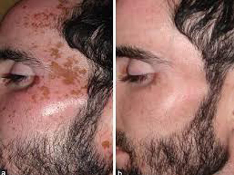 nd yag laser treatment