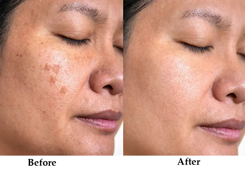 nd yag laser treatment