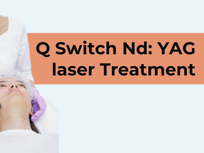 best nd yag laser machine