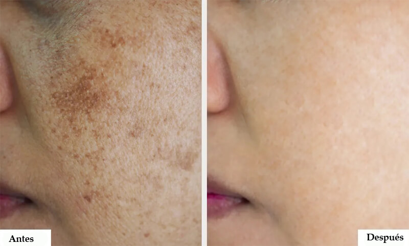 nd yag laser treatment