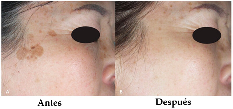 nd yag laser treatment