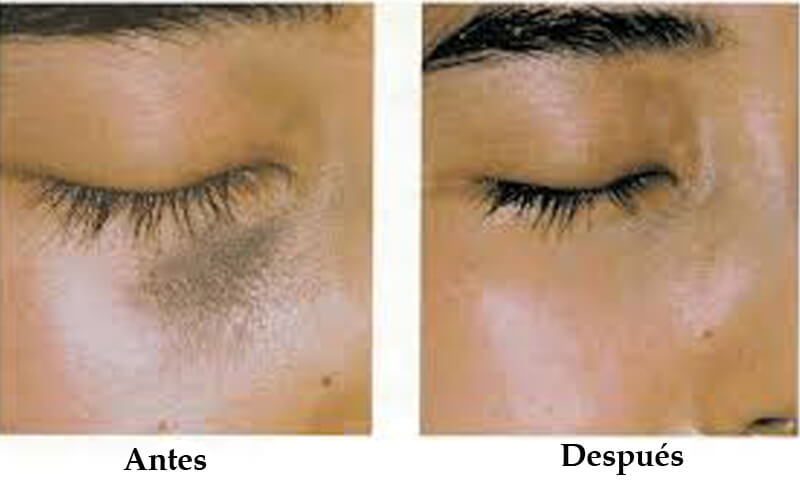 nd yag laser treatment