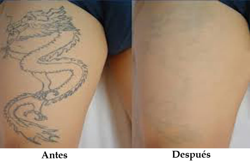 nd yag laser treatment