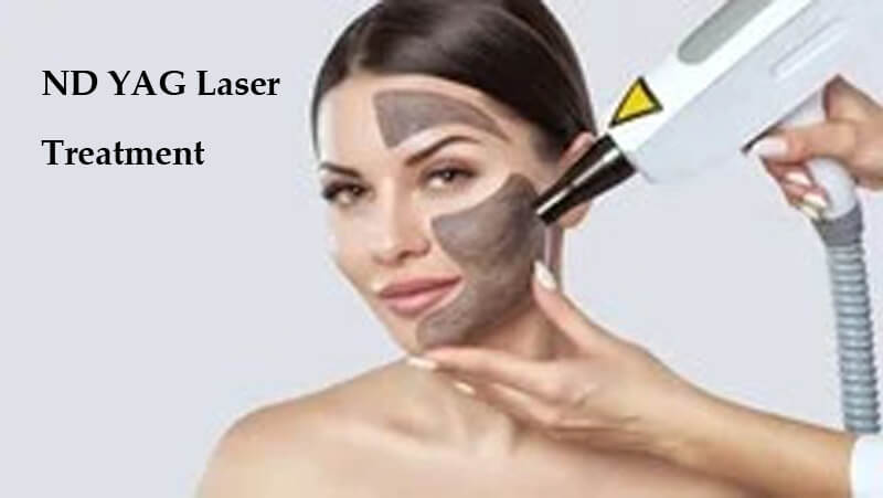 nd yag laser machine