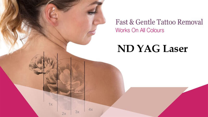 best nd yag laser machine