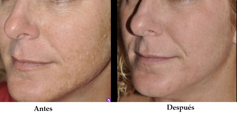 thulium laser treatment