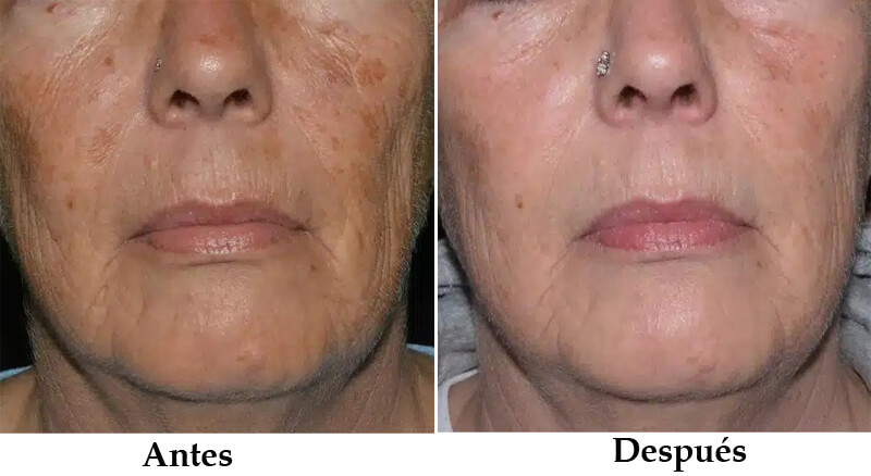 thulium laser treatment