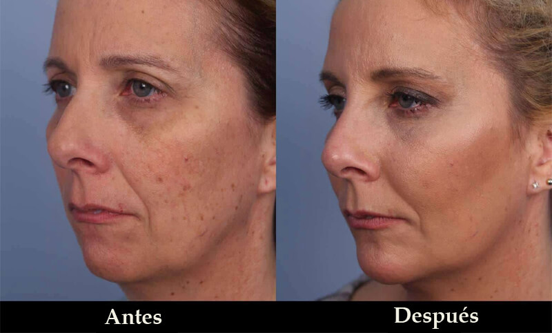 erbium laser resurfacing
