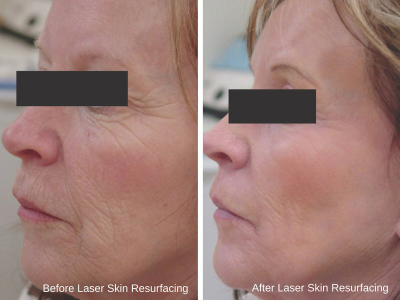 erbium laser resurfacing