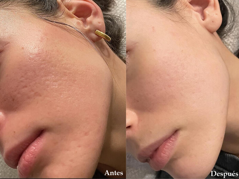 erbium laser resurfacing