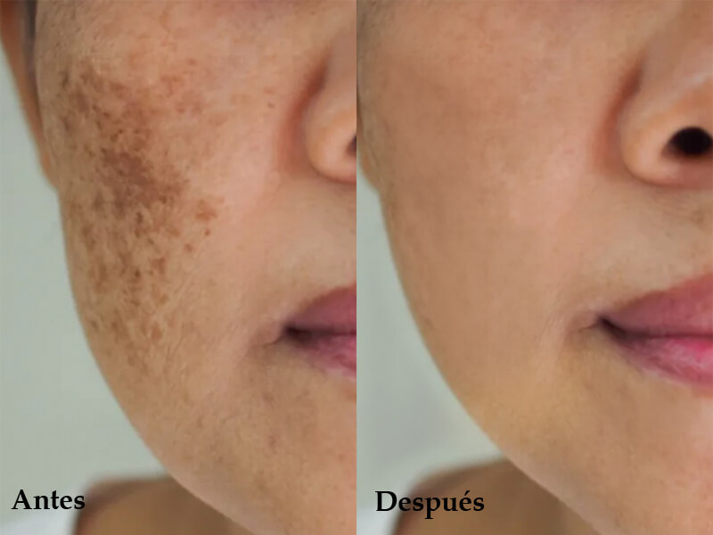 picosecond laser treatment