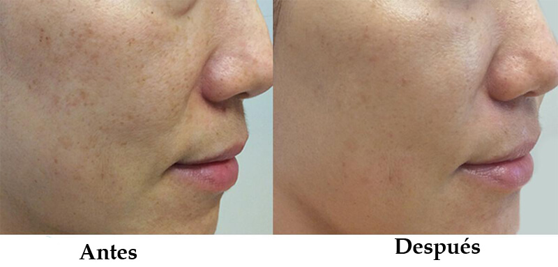 picosecond laser treatment