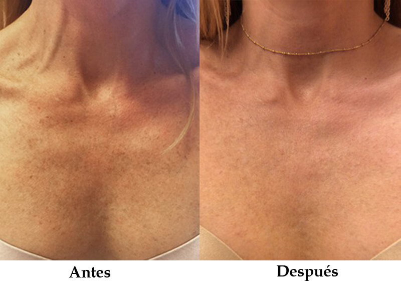 picosecond laser treatment