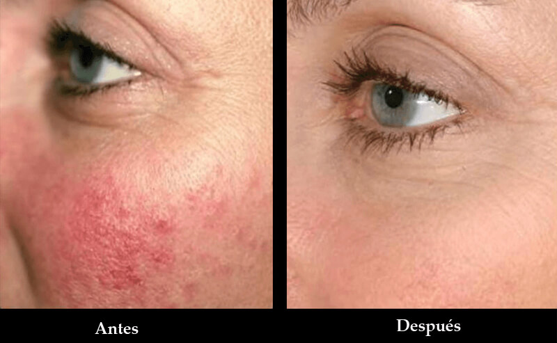 thulium laser treatment